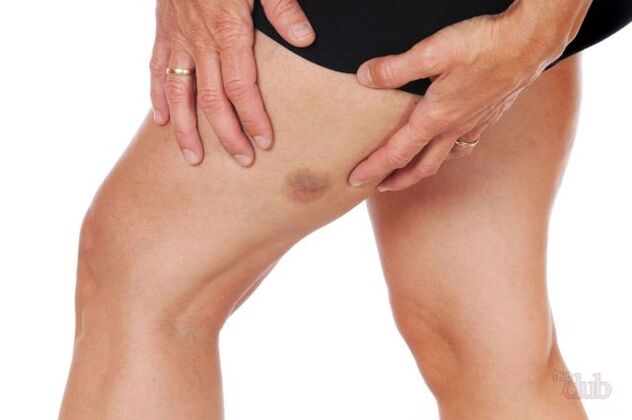 eğer bir damar patlarsa