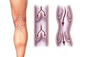 hastalık gelişiminin farklı aşamalarında varisli damarlardan kan çıkışı